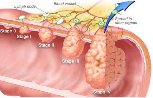 winslow_rm_illustration_of_colorectal_cancer_stages.jpg