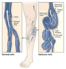 варикоз вен, тромбоз, отеки ног, язва венозная