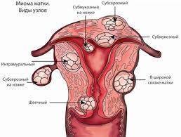 лейомиома матки, маточное кровотечение, опухоль матки, гинеколог, эндокринолог