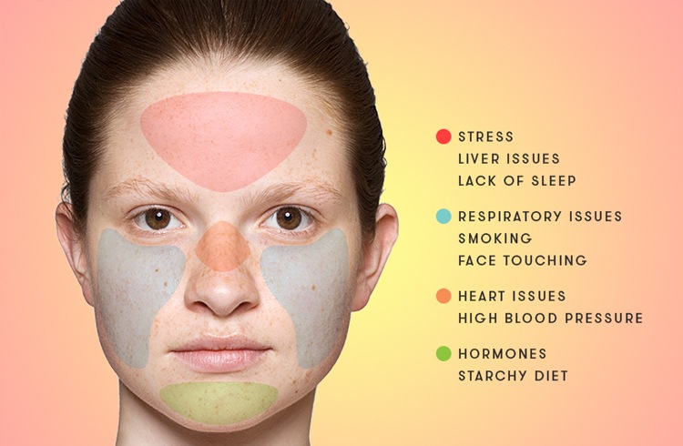 acne-face-map.jpg