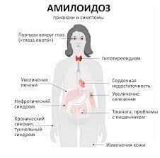 амилоидоз почек, амилоидоз внутренних органов, почечная недостаточность, нефролог, педиатр
