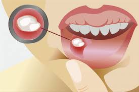 стоматит, афты рта, лечение у стоматолога