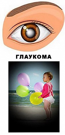 Glaukoma-7.jpg