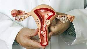 фибромиома матки, узлы в матке, маточные кровотечения, гинеколог, эндокринолог