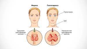 Гипотиреоз: основные причины появления и симптомы