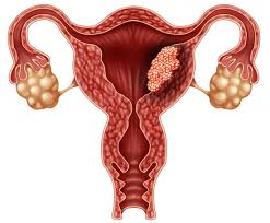 Рак тела матки.jpg