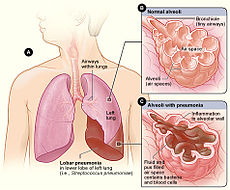 230px-Lobar_pneumonia_illustrated.jpg